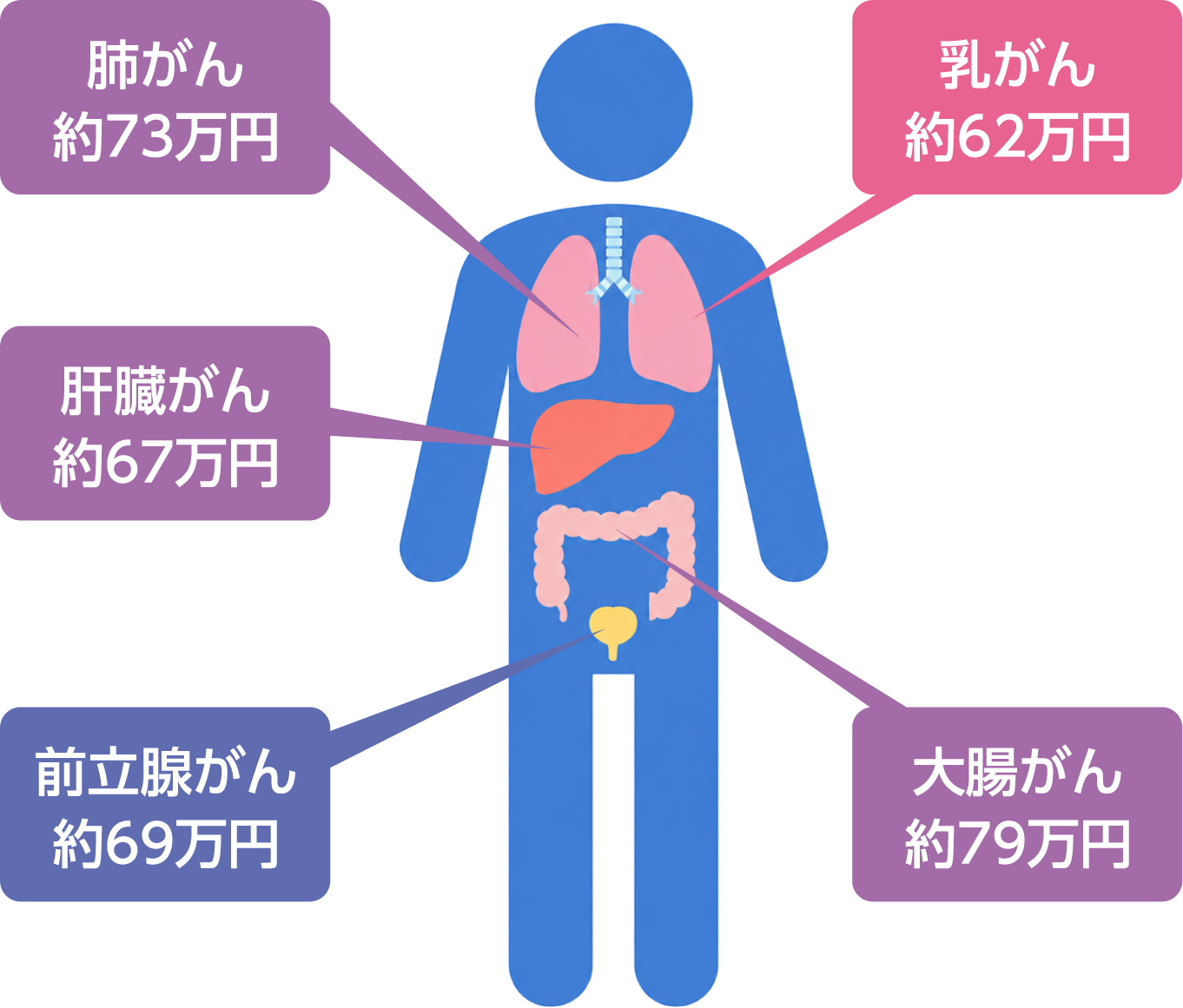 乳がん約62万円、大腸がん約79万円、肺がん約73万円、肝臓がん約67万円、前立腺がん約69万円